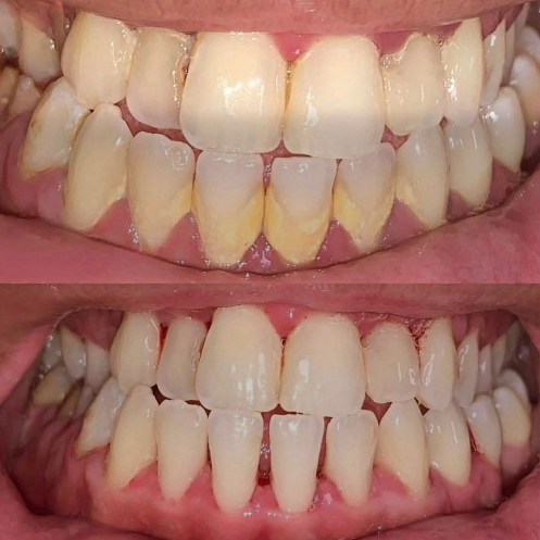 Antes y después — Limpieza Profunda
