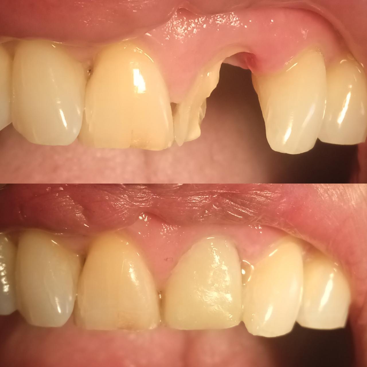 Antes y después — Implante Dental