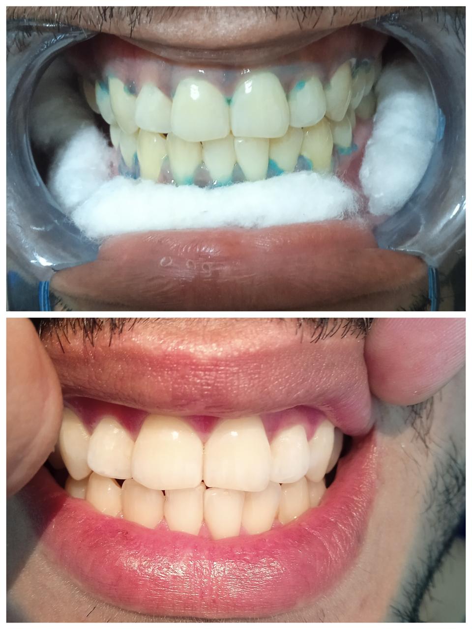 Antes y después — Blanqueamiento Dental